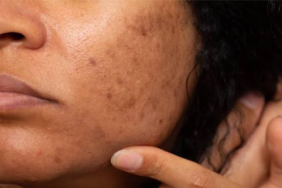 xây dựng thói quen chăm sóc da một cách khoa học cũng góp phần quan trọng kiểm soát và giảm thiểu hiện tượng đốm nâu trên da mặt.