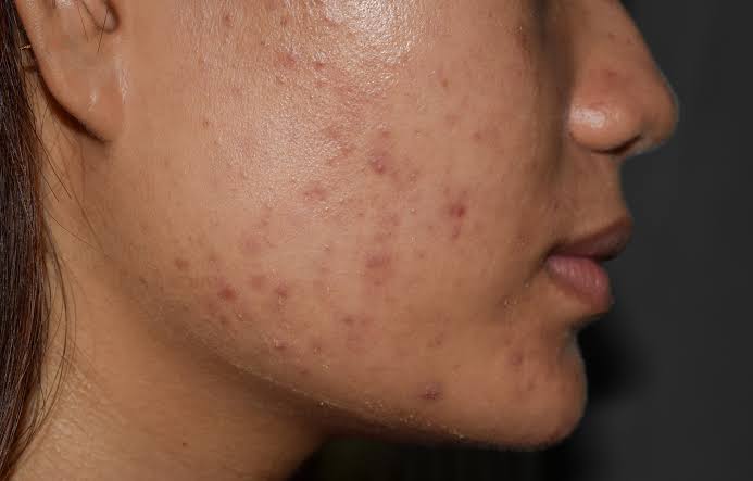Đốm nâu trên da mặt là tình trạng nhiều người gặp phải, gây ảnh hưởng không nhỏ đến thẩm mỹ và sự tự tin