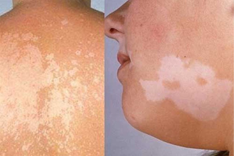 hiểu rõ đốm trắng trên da nguyên nhân do đâu, việc điều chỉnh lại lối sống và chăm sóc da là cực kỳ quan trọng nhằm hỗ trợ phòng ngừa và cải thiện tình trạng này.