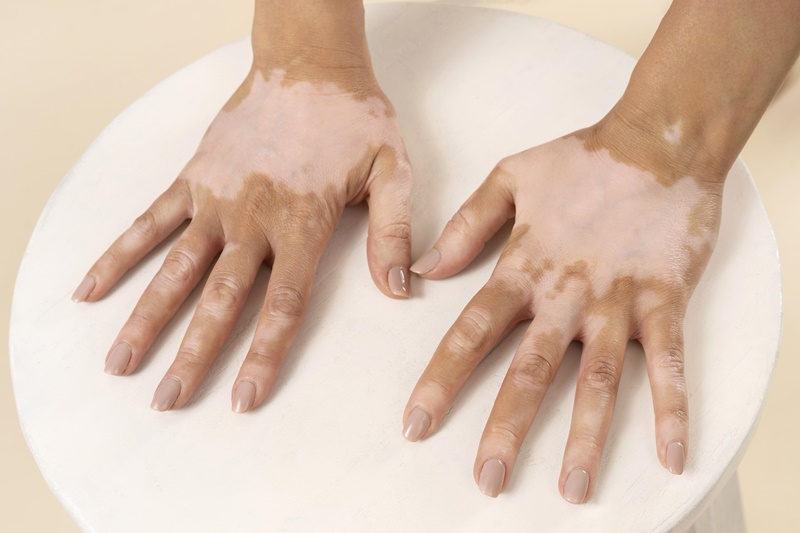 Câu hỏi giảm sắc tố da là gì đã được giải thích về mặt nguyên nhân và biểu hiện.