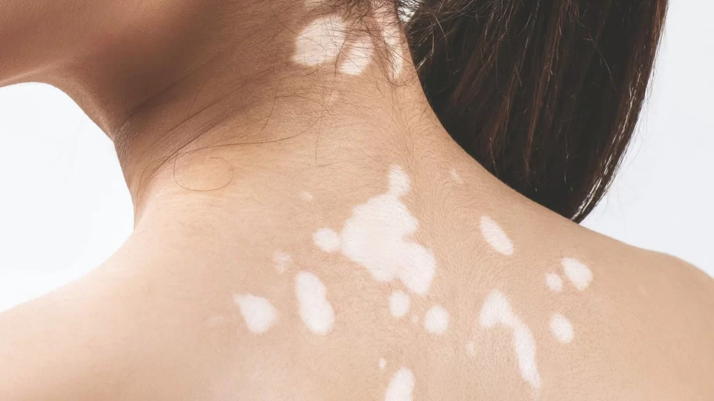 Giảm sắc tố da là một vấn đề gây nhiều băn khoăn cho những ai muốn duy trì làn da đều màu và khỏe mạnh
