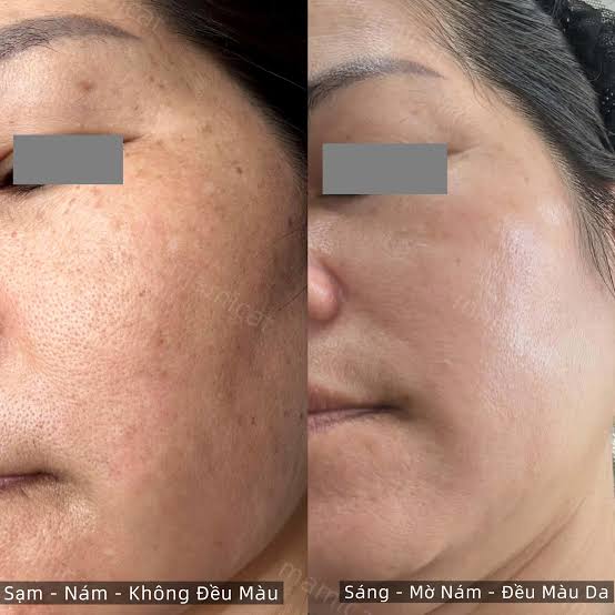 Các hoạt chất làm sáng da và mờ nám chính là yếu tố then chốt giúp đạt được mục tiêu này