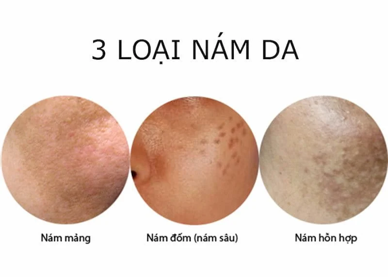 Khi nám da ở mức độ dày, sâu hoặc lan rộng, việc chăm sóc da cơ bản tại nhà có thể chưa đủ hiệu quả.