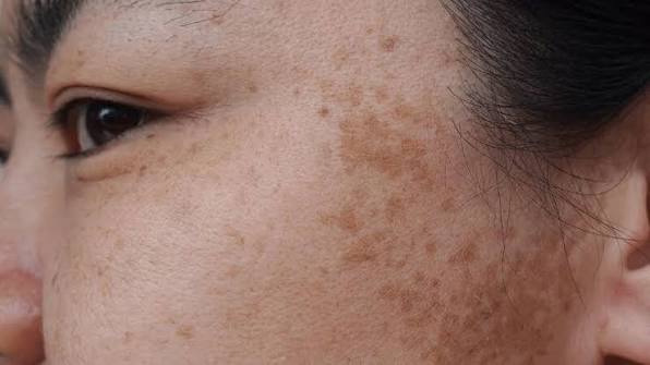 Nám da gây ra không ít phiền toái trong cuộc sống và làm giảm sự tự tin của nhiều người, đặc biệt là phụ nữ