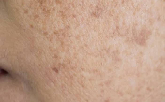 Với nám da do lão hóa, kiên trì trong chăm sóc và điều trị kết hợp bảo vệ đúng cách sẽ giúp nâng cao chất lượng làn da và cải thiện các vết nám