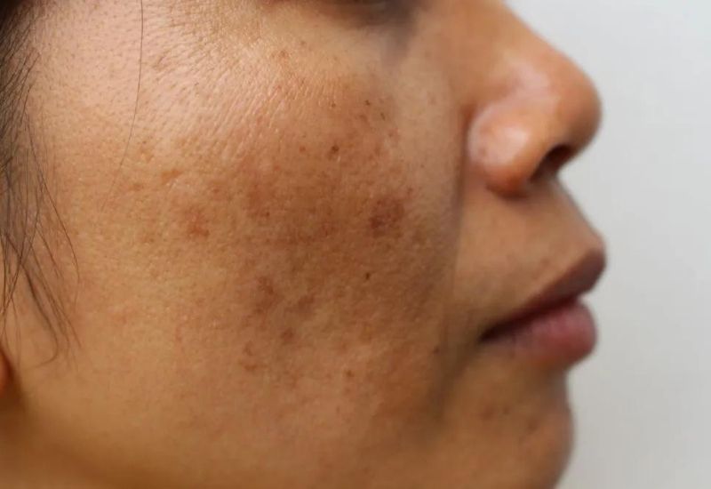 hiểu rõ nguyên nhân cũng như cách chăm sóc nám da do lão hóa sẽ giúp hạn chế và làm giảm các biểu hiện nám da do lão hóa hiệu quả hơn.