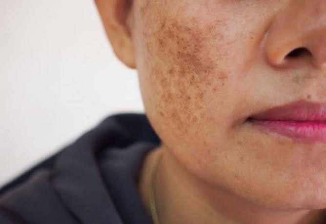 Phòng ngừa nám da do rối loạn nội tiết tố không thể thiếu yếu tố bảo vệ da khỏi tia UV – một trong những tác nhân hàng đầu kích thích nám phát triển.