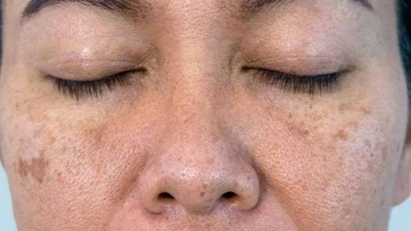 Phân biệt nám do stress hay loại nám do các nguyên nhân khác là điều cần thiết để có chiến lược xử lý hợp lý.