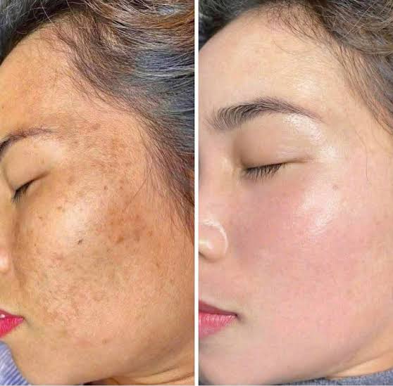 xử lý nám da do stress đòi hỏi sự kiên trì và lựa chọn phù hợp từ chế độ chăm sóc đến lối sống lành mạnh.