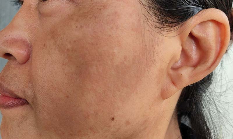 Nếu nám da trở nên nghiêm trọng hoặc kéo dài, bạn có thể tìm đến các liệu pháp chăm sóc da tại viện thẩm mỹ hoặc spa chuyên sâu