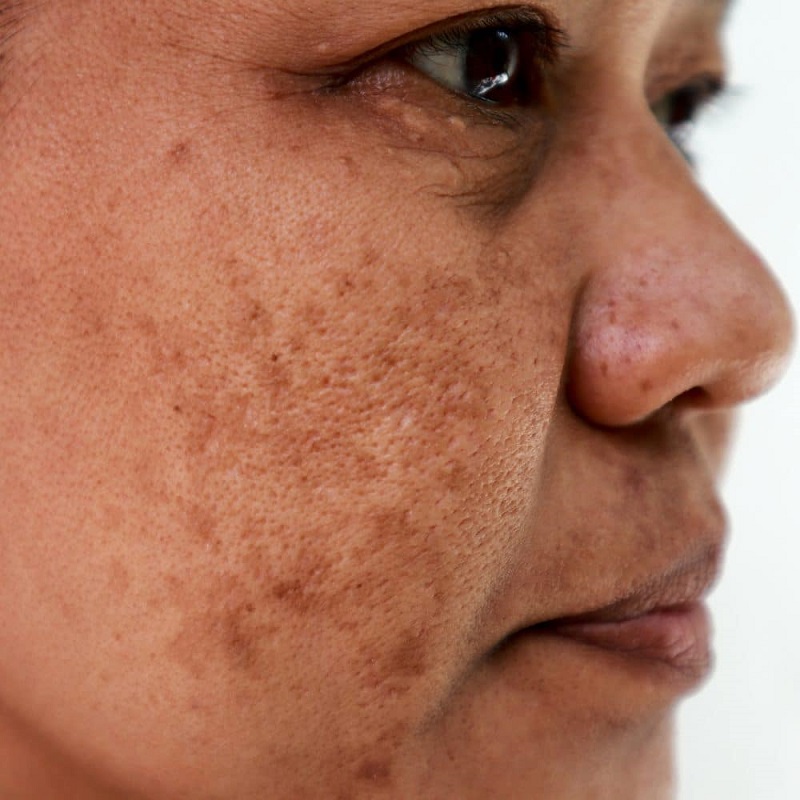 Để xử lý hiệu quả, cần nắm rõ các đặc điểm của nám da ở hai bên gò má.