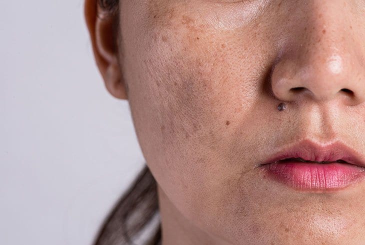 Nám da lâu năm có điều trị được không phụ thuộc rất nhiều vào sự kết hợp đồng bộ giữa các yếu tố khoa học, kỹ thuật và lối sống lành mạnh.