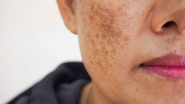Người bị nám da nội tiết có thể cân nhắc điều chỉnh chế độ ăn uống, sinh hoạt như ngủ đủ giấc, giảm căng thẳng và cân bằng thể chất