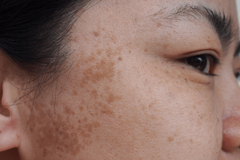 Skinlab luôn hiện diện là người bạn đồng hành đáng tin cậy để bạn yên tâm nuôi dưỡng vẻ đẹp khỏe mạnh, hạn chế nám quay trở lại hiệu quả.
