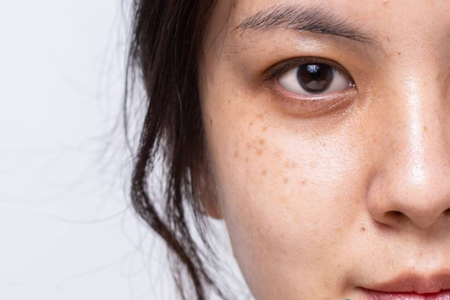 Đa phần nám da sau sinh cải thiện tốt khi được chăm sóc khoa học