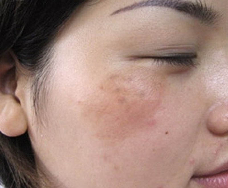 Nhận diện và kiểm soát nguyên nhân gây nám da mặt không chỉ bảo vệ vẻ ngoài mà còn giúp duy trì làn da khỏe mạnh lâu dài.