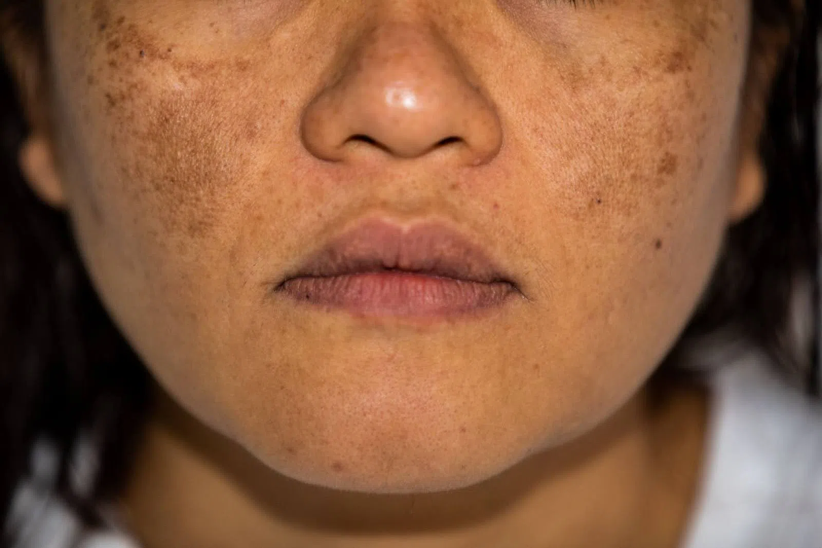 Các thói quen như thức khuya, căng thẳng, thiếu ngủ hoặc chăm sóc da sai cách, gây tổn thương lớp biểu bì cũng tác động làm nám sạm nghiêm trọng