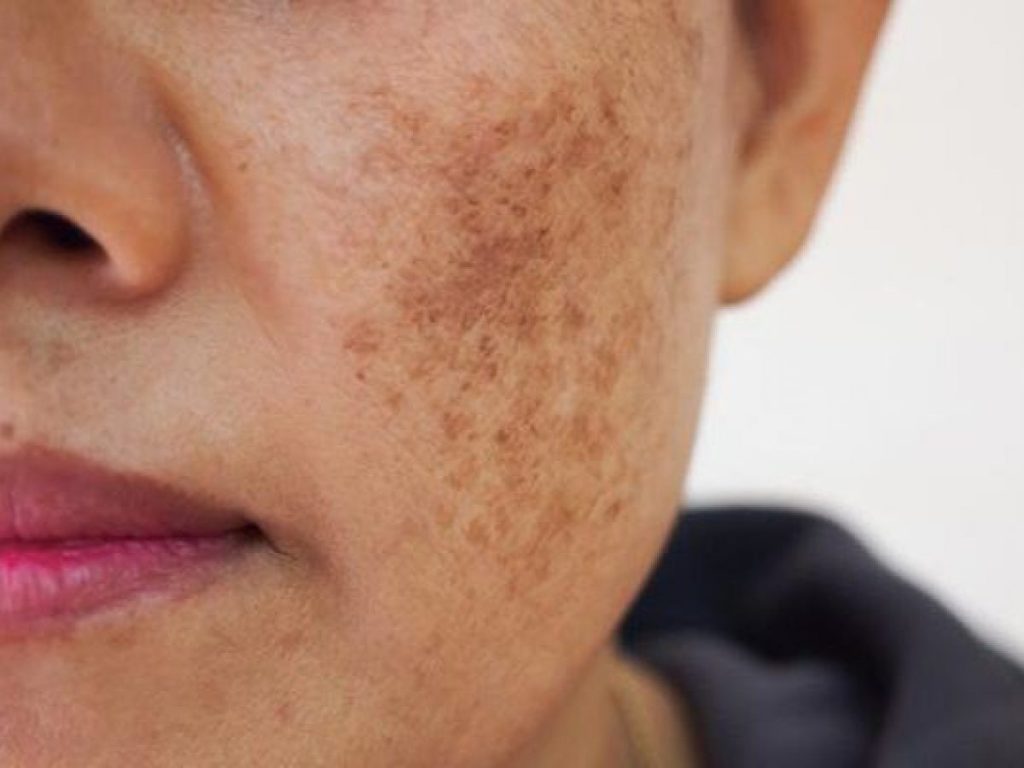 Việc xử lý nguyên nhân tăng sắc tố da cần có quy trình chăm sóc bài bản, cá nhân hóa.