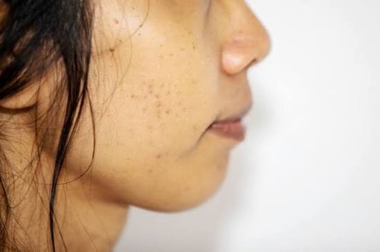 khi cơ chế sản xuất melanin hoạt động không ổn định, khiến sắc tố da mất cân bằng, hiện tượng rối loạn melanin trên da xảy ra
