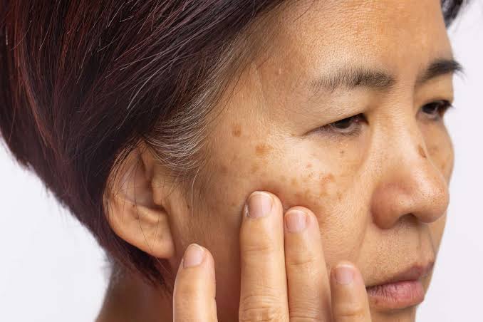 rối loạn sắc tố da có nguy hiểm không? Đây là câu hỏi được nhiều người quan tâm khi đối mặt với những biến đổi màu da bất thường
