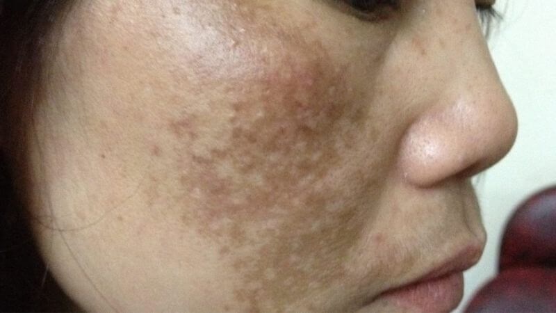 Chăm sóc da đúng cách giúp hạn chế phát sinh hoặc kiểm soát tình trạng rối loạn sắc tố da ở mặt.