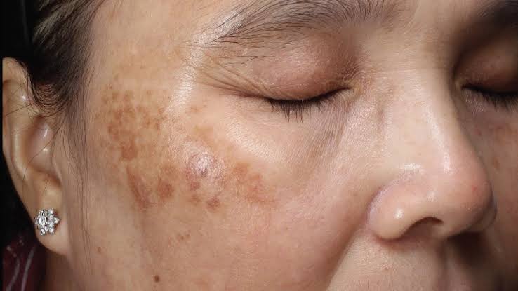 Rối loạn sắc tố da sau viêm là một tình trạng khiến nhiều người e ngại bởi sự xuất hiện của các vết thâm, nám sau tổn thương