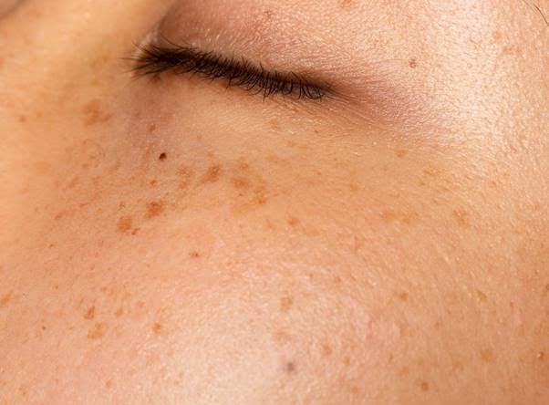 Một routine skincare cho da nám không phải lúc nào cũng cố định mà nên dựa trên tình trạng da hiện tại