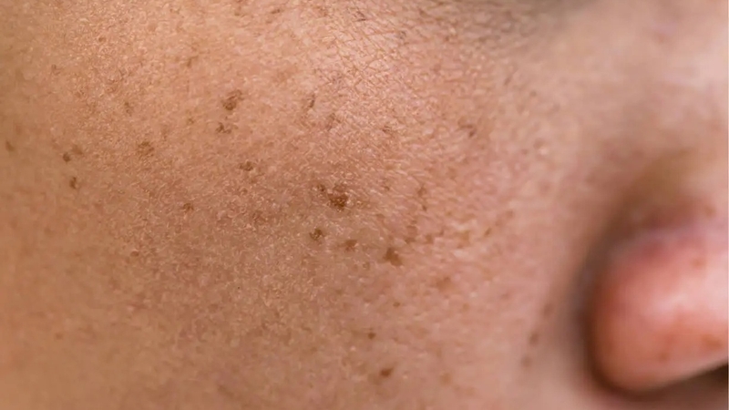 routine skincare cho da nám được thiết kế linh hoạt dựa trên đặc điểm da và tiến trình cải thiện nám của mỗi khách hàng