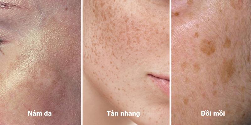 Hiểu rõ tàn nhang và nám da khác nhau thế nào sẽ giúp bạn nhận diện chính xác tình trạng da