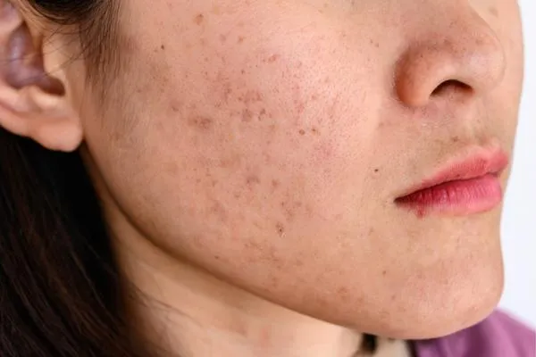hiểu rõ tàn nhang và nám da khác nhau thế nào sẽ giúp điều chỉnh phương pháp chăm sóc và lựa chọn sản phẩm đúng đắn hơn