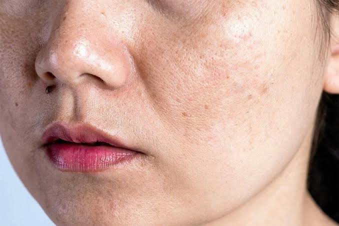 Tăng sắc tố da do nội tiết là hiện tượng thường thấy khiến vùng da xuất hiện những vết sẫm màu không đều, làm ảnh hưởng đến thẩm mỹ làn da