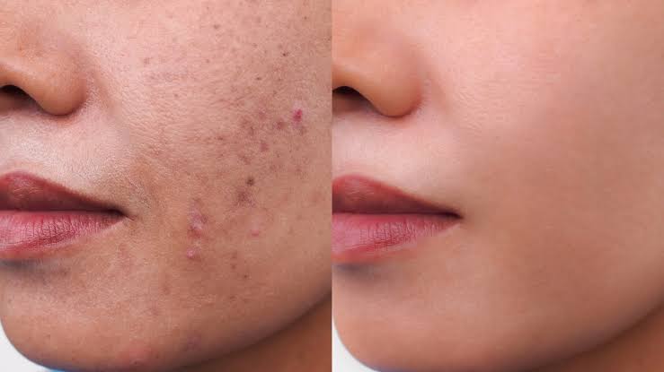 giữ cho da luôn được bảo vệ, đủ ẩm và tránh các chiều hướng tổn hại là một phần thiết yếu trong quá trình chăm sóc da tăng sắc tố sau viêm